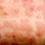 Measles is highly infectious. 1 person can infect 15 other unvaccinated people on average.