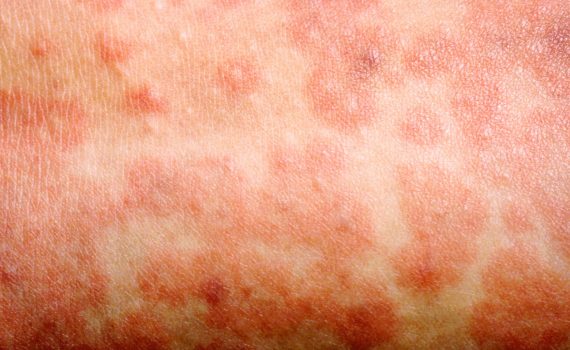 A_1017_measles-rash_D1BM7H.width-1534